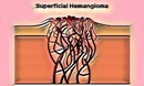 Hemanjiom Nedir Hemanjiom Tedavisi Nasıl Yapılır?