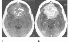 Beyinde Hemanjiom Belirtileri ve Tedavisi