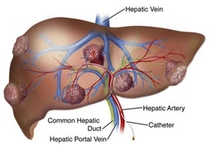Karaciğer Hemanjiom Belirtileri ve Tedavisi