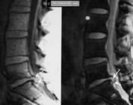 Vertebra Korpusunda Hemanjiom Belirtileri ve Tedavisi