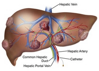 Karaciğer Hemanjiom Ağrısı Belirtileri ve Tedavisi