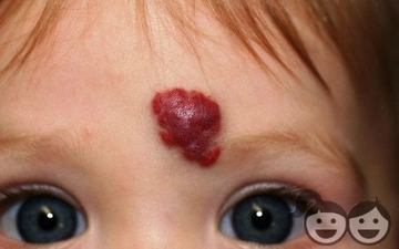 Yüzde Hemanjiom Belirtileri ve Tedavisi